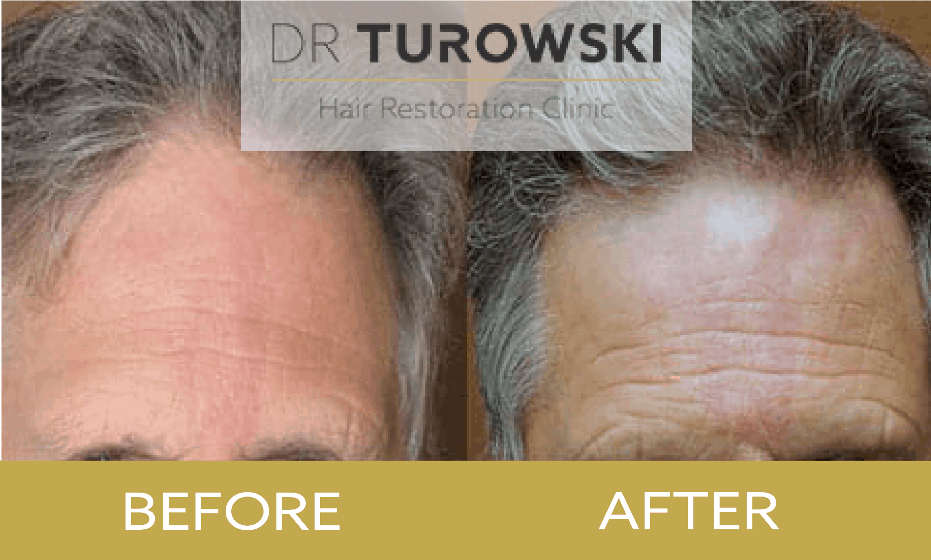 Hair Transplant Procedure Recovery Side Efffects Results Dr Turowski