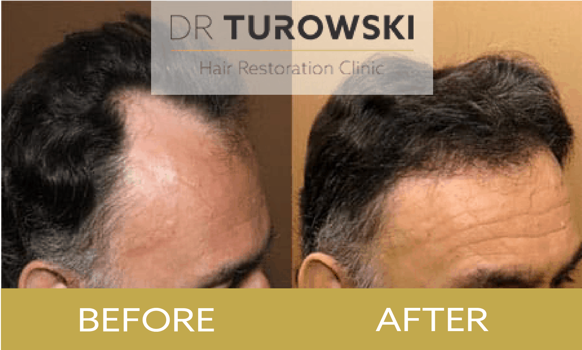 Hair Transplant Procedure Recovery Side Efffects Results Dr Turowski