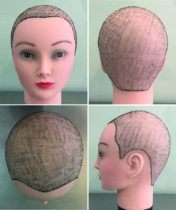 konsultacja online przeszczep włosów katowice